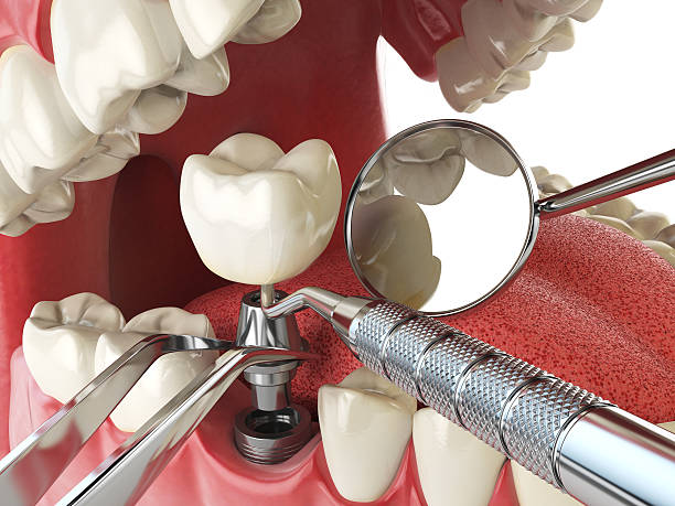 Best Emergency Tooth Extraction in Wytheville, VA