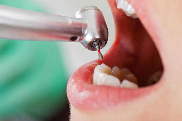 Best Emergency Tooth Extraction in Wytheville, VA